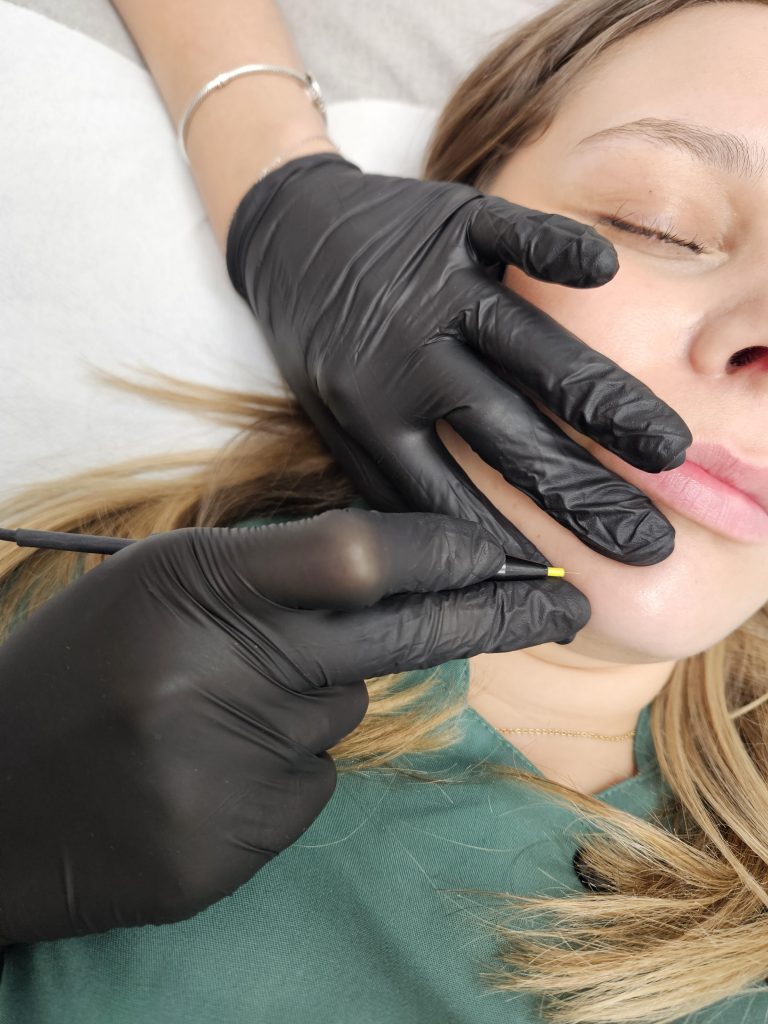 épilation éléctrique saint-avold