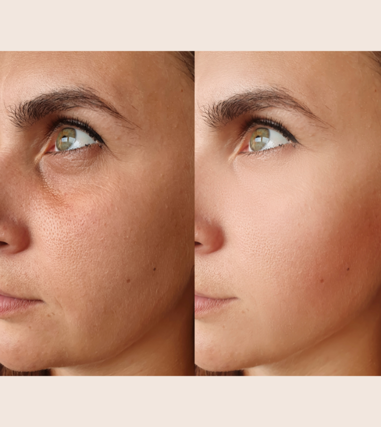 bienfaits traitement skinboosters